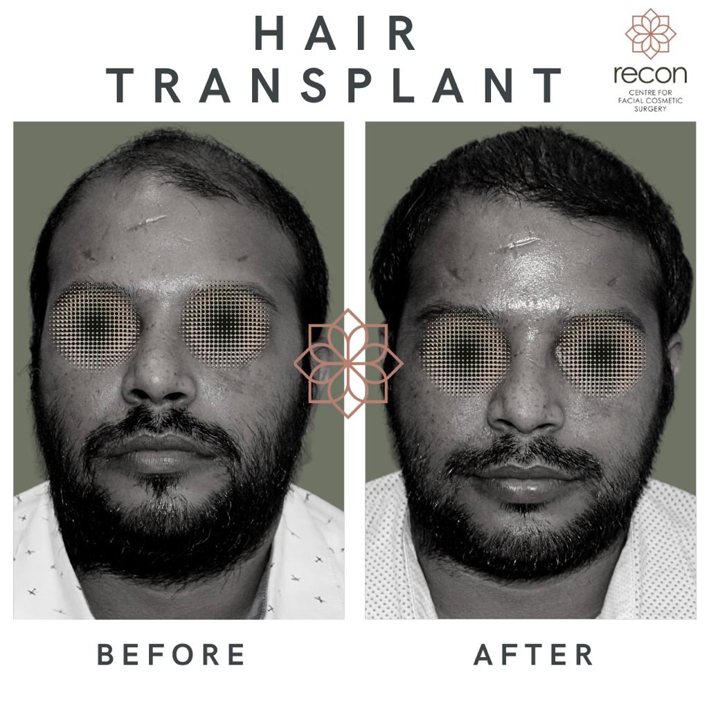 Hair transplant in delhi